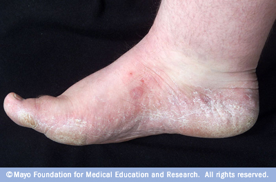Excessively Thick Dry Skin on Feet and Hands - LoveToKnow